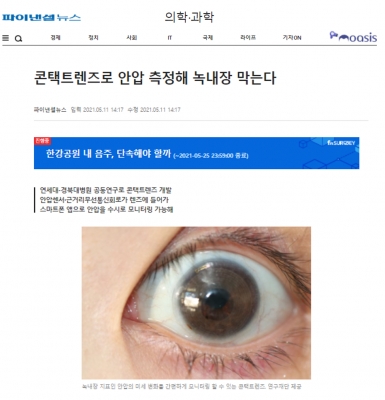 파이낸셜뉴스: 콘택트렌즈로 안압 측정해 녹내장 막는다